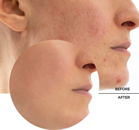Revox B77 Skintreats Biotic Rebalancing Smoothing Gel ľahký gélový krém na vyhladenie a zmatnenie pleti