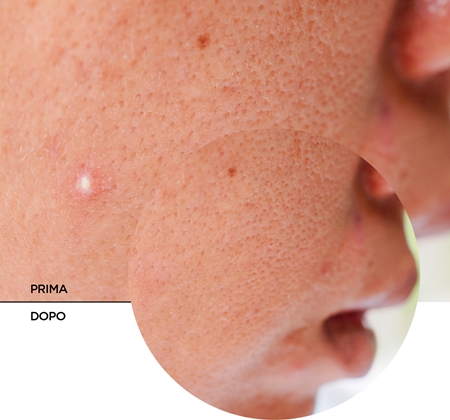 Revox B77 JUST Succinic Acid trattamento localizzato anti-acne