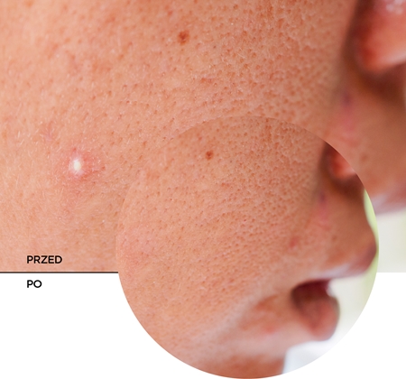 Revox B77 JUST Succinic Acid pielęgnacja miejscowa przeciw trądzikowi