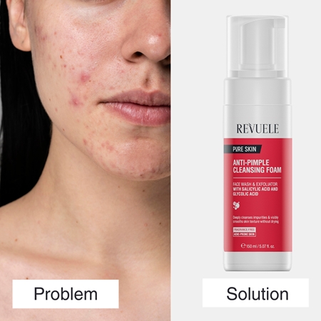 Revuele Pure Skin Anti-Pimple mousse detergente per pelli problematiche, acne