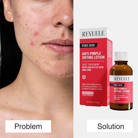 Revuele Pure Skin Anti-Pimple τοπική φροντίδα κατά της ακμής