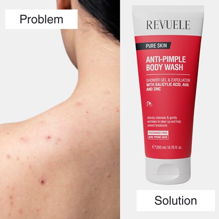 Revuele Pure Skin Anti-Pimple Exfoliating Shower Gel to treat acne