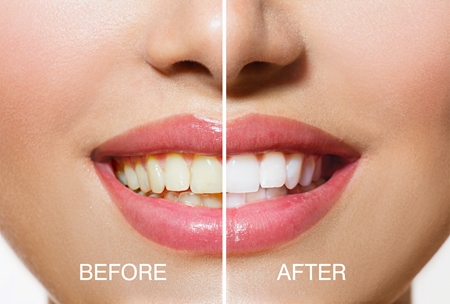 RIO USB teeth whitening kit de blanchiment dentaire
