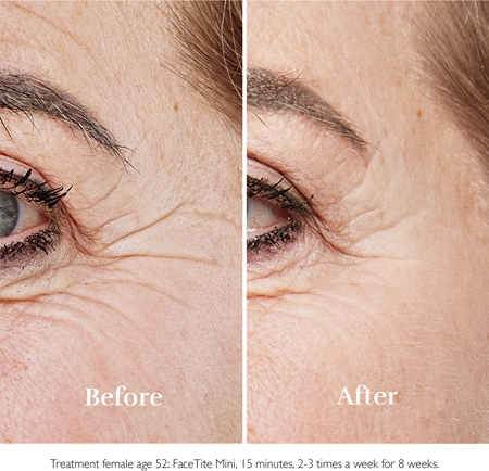 Silk'n FaceTite Mini wrinkle smoothing and reducing device around the eyes and lips