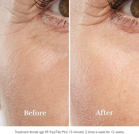 Silk'n FaceTite Mini wrinkle smoothing and reducing device around the eyes and lips