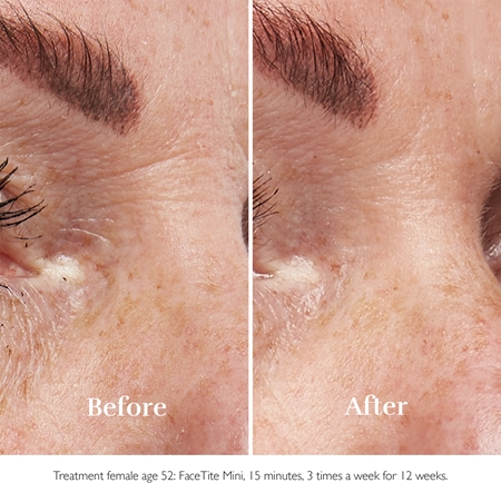 Silk'n FaceTite Mini wrinkle smoothing and reducing device around the eyes and lips
