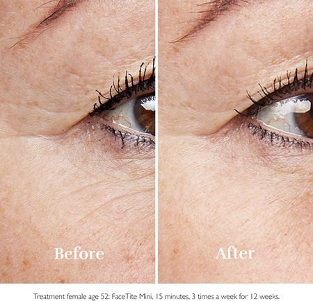 Silk'n FaceTite Mini wrinkle smoothing and reducing device around the eyes and lips
