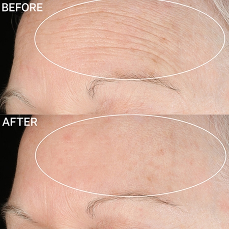 StriVectin Anti-Wrinkle SD Advanced Plus koncentrovaný krém redukující vrásky