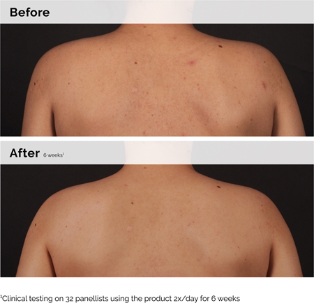 The Ordinary Salicylic Acid 0.5% Body Serum Perfecting Body Serum with salicylic acid