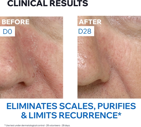 Uriage DS Regulating Soothing Emulsion Soothing Emulsion for seborrheic dermatitis
