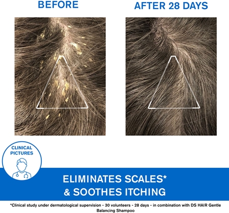 Uriage DS HAIR Kerato-Reducing Treatment Shampoo keratoredukční šampon pro citlivou a podrážděnou pokožku