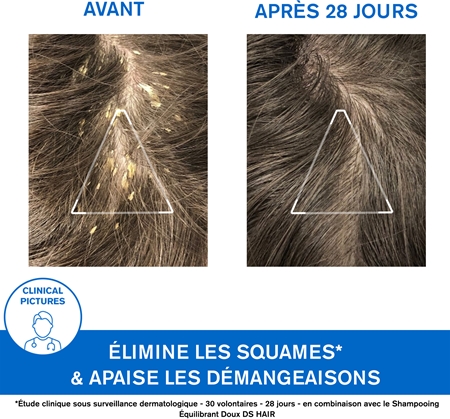 Uriage DS HAIR Kerato-Reducing Treatment Shampoo shampoing kératoréducteur pour peaux sensibles et irritées