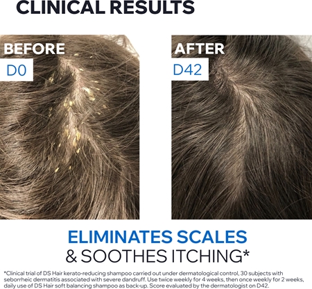 Uriage DS HAIR Kerato-Reducing Treatment Shampoo kerato-redukcijski šampon za občutljivo in razdraženo kožo