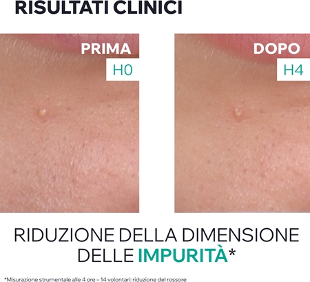 Uriage Hyseac SOS Drying Gel gel per l'acne uso localizzato contro le imperfezioni della pelle