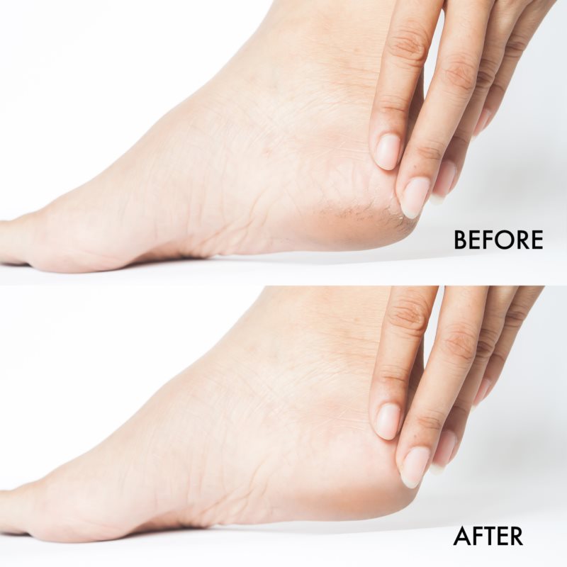 Emi Care System Crack Treat Cream легкий відновлювальний крем для потрісканої шкіри ніг 300 мл