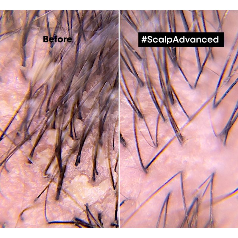 L’Oréal Professionnel Serie Expert Scalp Advanced шампунь проти лупи 300 мл