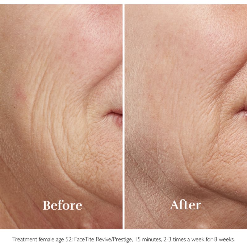 Silk'n FaceTite Prestige Device For Smoothing And Reducing Wrinkles 1 Pc