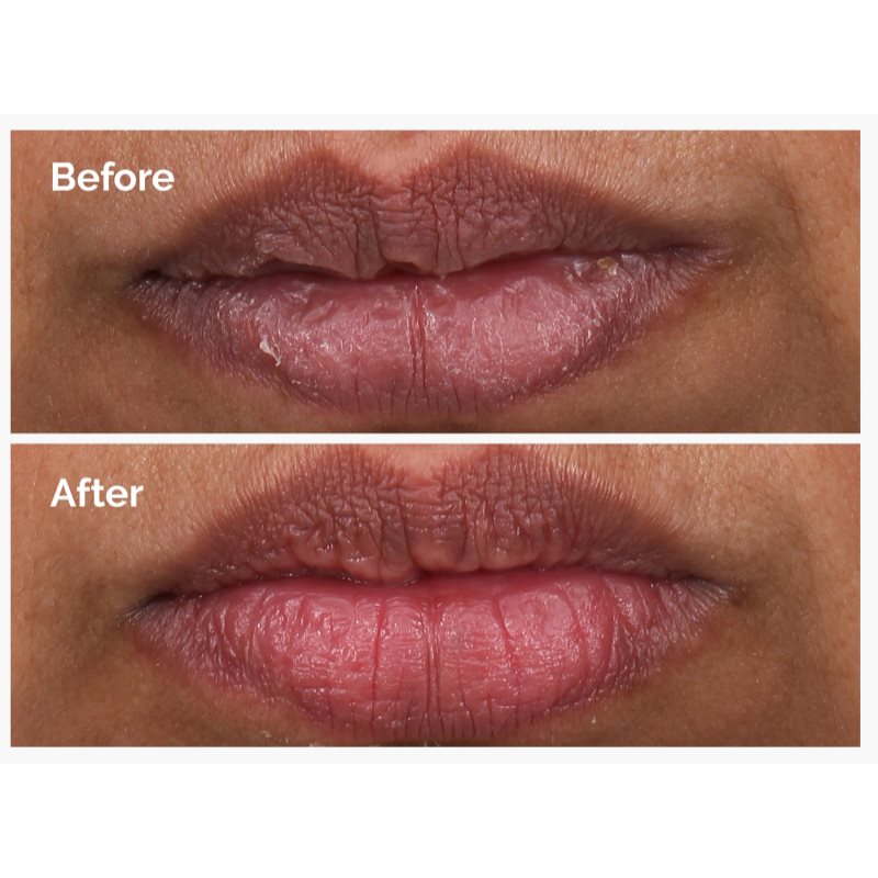 The Ordinary PHA 5% Exfoliating Lip Serum vyhlazující exfoliační sérum na rty 15 ml (obrázek 3)