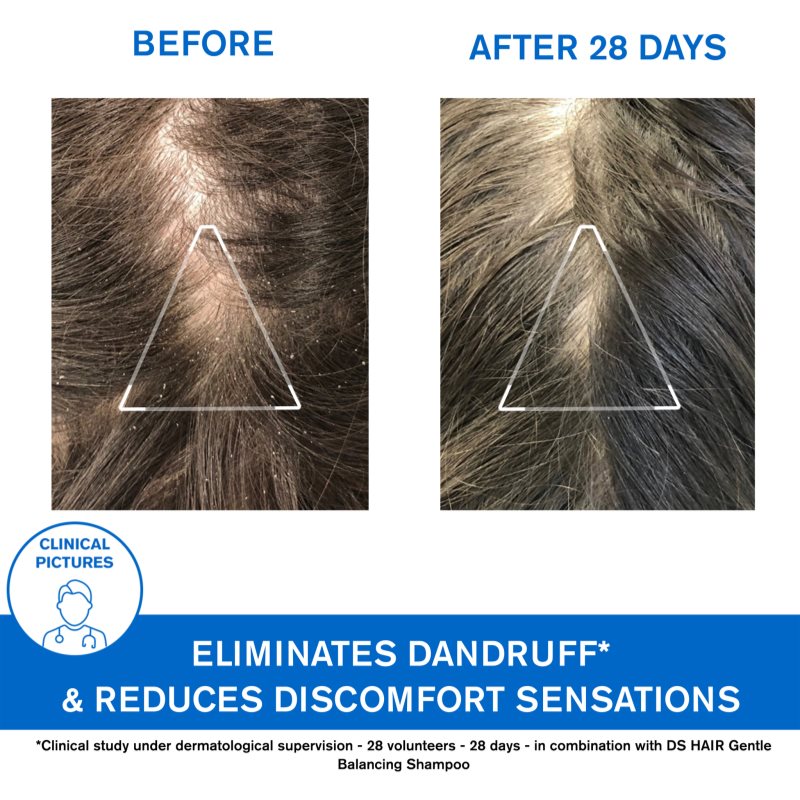 Uriage DS HAIR Anti-Dandruff Treatment Shampoo шампунь проти лупи для подразненої шкіри голови 200 мл