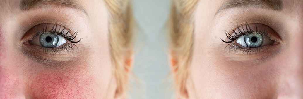 Rosacea e couperose