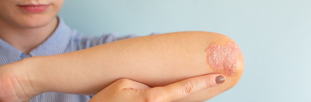 Psoriasi sulle braccia