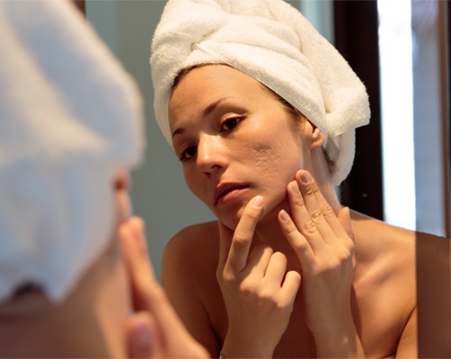 Comment éliminer les cicatrices d'acné | Taches et traces d'acné ...