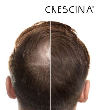 LABO Crescina Transdermic Rapid Intensive – Doppelbehandlung Gegen Haarausfall, 20+20 Ampullen, Für Frauen 500