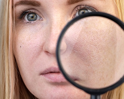 Primo piano del naso di una donna con punti neri o punti neri problemi di  acne comedoni pori dilatati